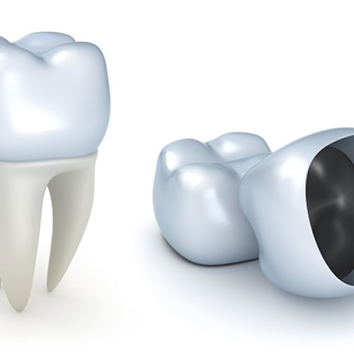 dental-crowns-2101