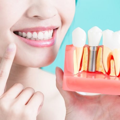 Woman,Take,Tooth,Implant,False,Tooth,On,Green,Background