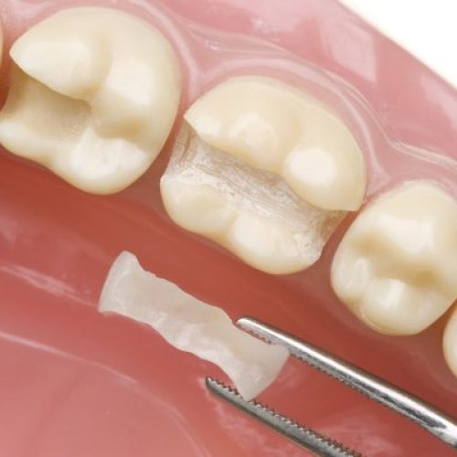 dental-sealants-2