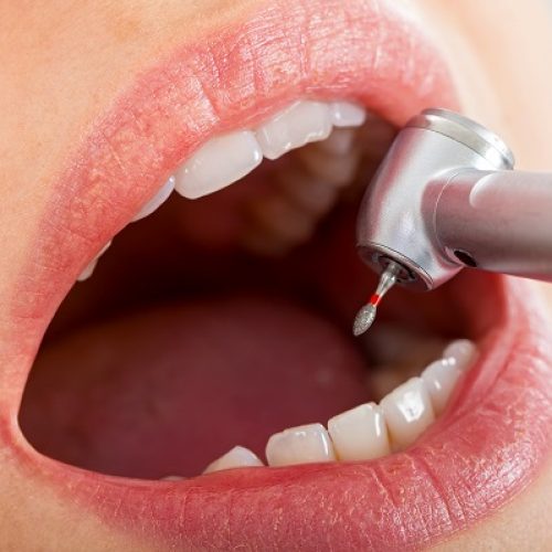 Close,Up,Picture,Of,Dental,Drill,In,Young,Female,Patient's