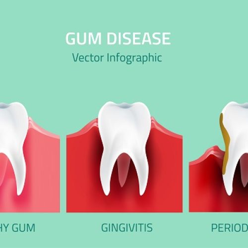 Teeth,Infographic.,Gum,Disease,Stages.,Editable,Vector,Illustration,In,Modern